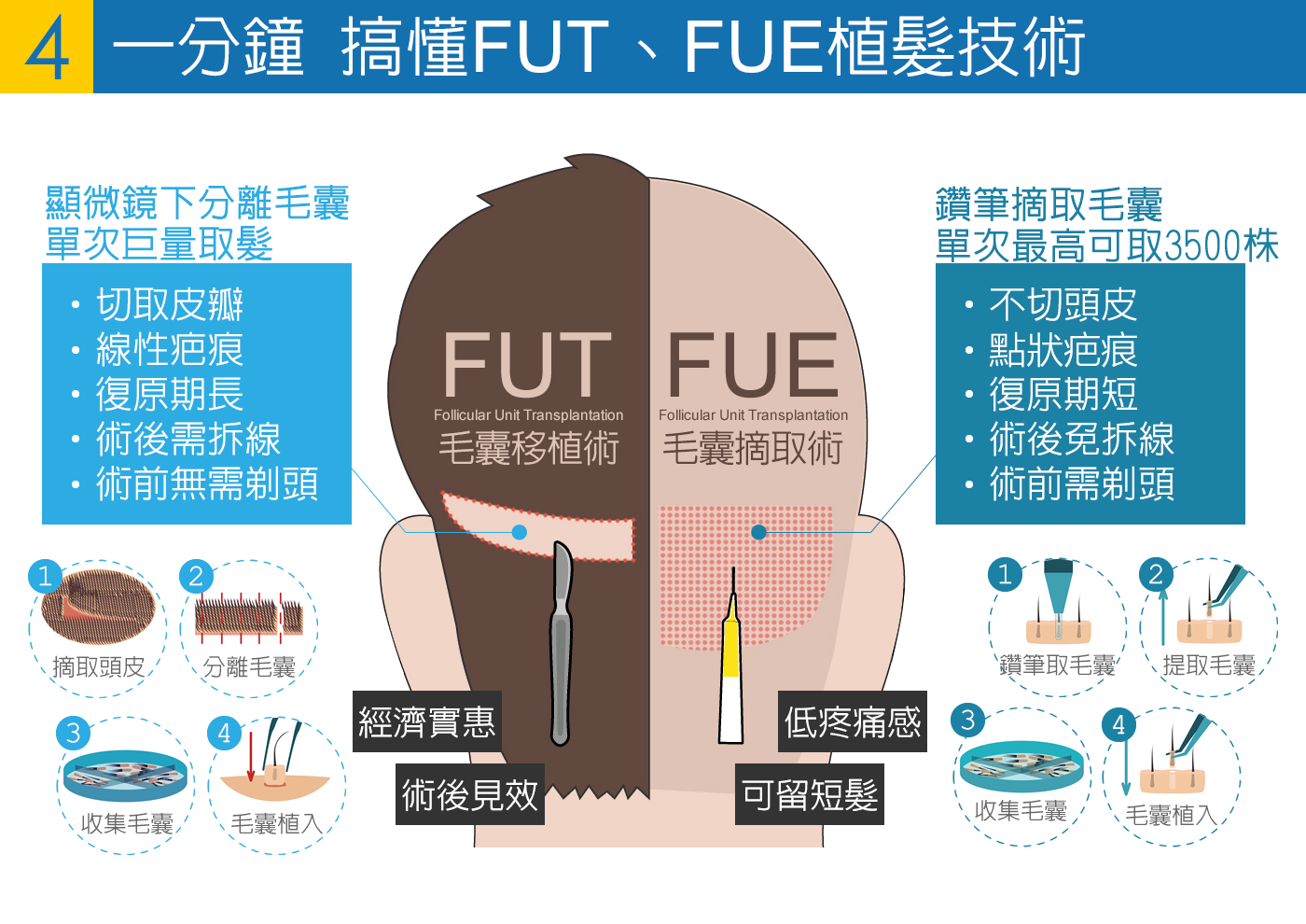 一分鐘 搞懂FUT、FUE植髮技術