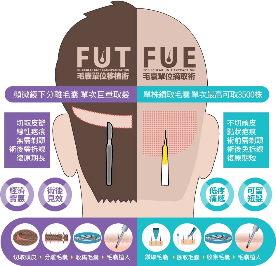 一分鐘搞懂FUT與FUE植髮術式