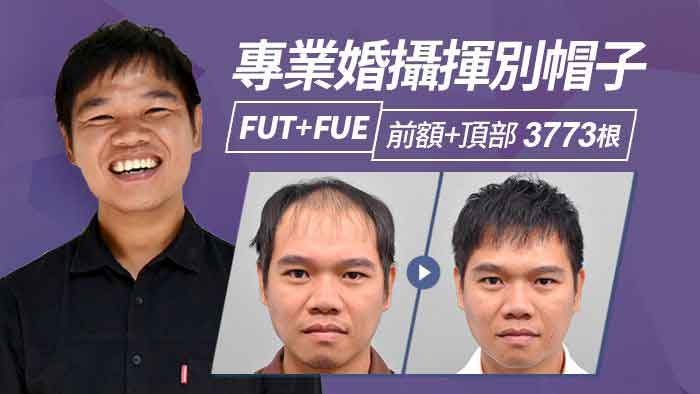 【雄性禿】專業婚攝植髮改善落髮 髮量濃密好滿意｜FUT+FUE前額+頂部植髮 -3773根