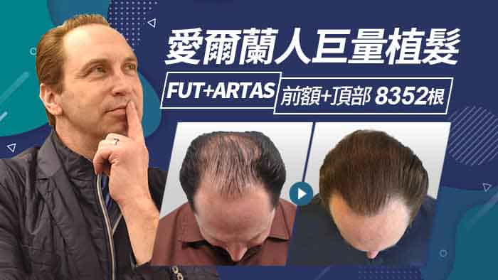 海外商務客來台巨量植髮 前額+頂部植髮 FUT術式+ARTAS術式-數量8352根
