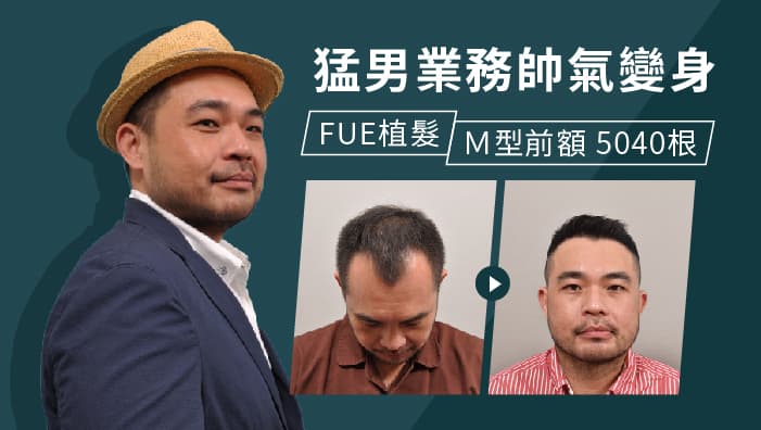 【M型禿】FUE植髮永久解決M型禿，馬來西亞型男業務帥氣變身–前額+頂部植 5040根