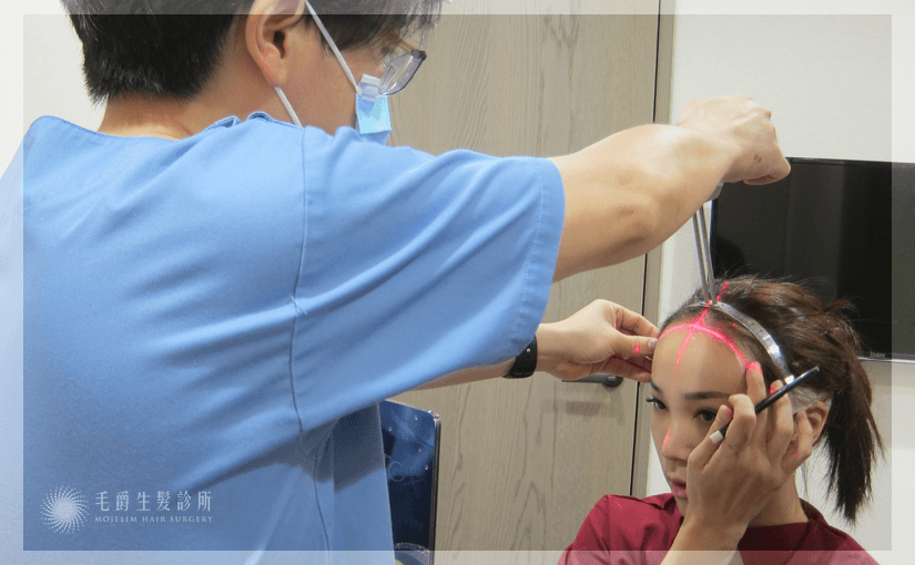 毛爵診所劉院長反覆與患者溝通，規劃出最合適的植髮區域。