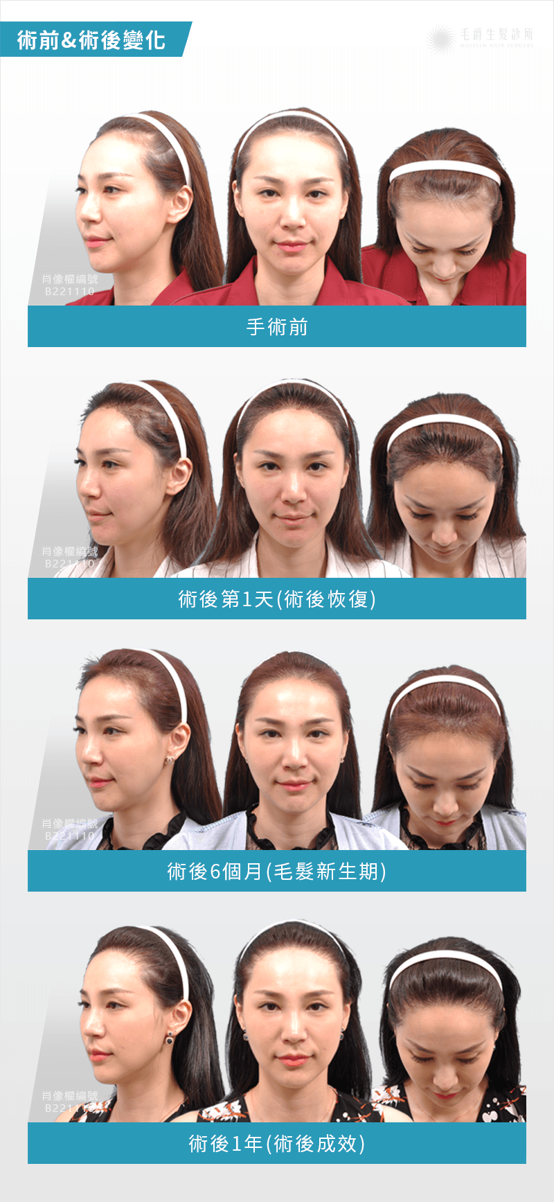 韓式美形植髮 醫美業務修飾高額髮線打造小臉 毛爵生髮診所