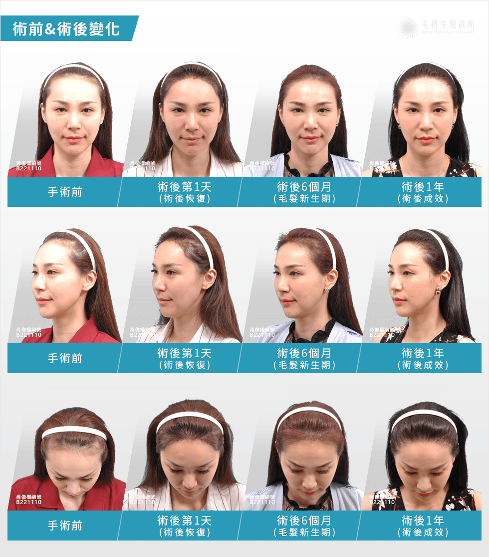 韓式美形植髮 醫美業務修飾高額髮線打造小臉 毛爵生髮診所
