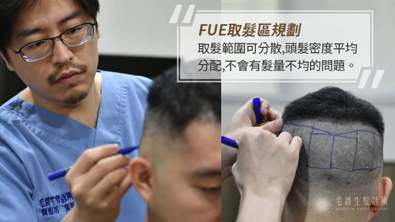 前額植髮 香港朋友steven來台植髮心聲 M字禿 Fue 植髮 毛爵生髮診所
