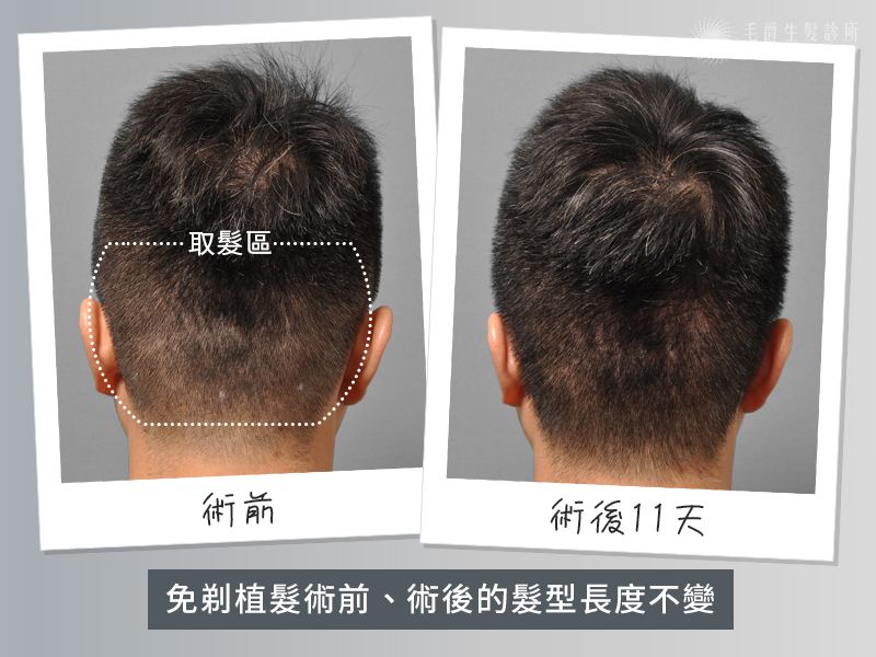 吳皓昇採用免剃植髮，術前後髮型長度不變,毛爵生髮診所,劉怡坊院長