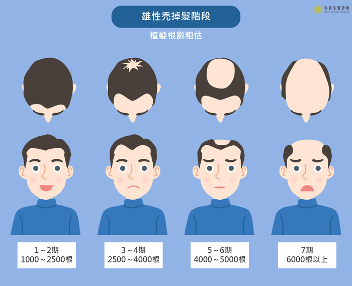 治療雄性禿仍是植髮的主要治療項目之一，根據雄性禿一至七期的掉髮嚴重程度，所需植髮量也不同