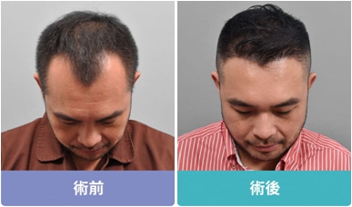 雄性禿前額植髮─M型禿髮際線植髮術後一年，髮友自信大增