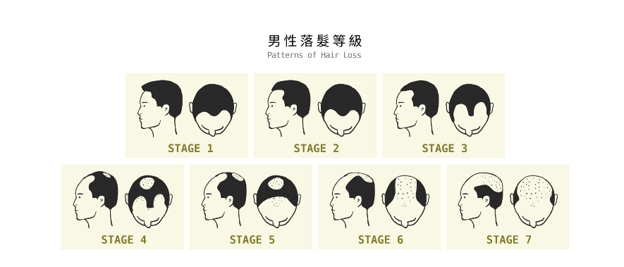 醫師詳解雄性禿五大常見疑問、落髮原因及如何治療 | 毛爵生髮診所Mojelim|ABHRS世界級植髮認證|生髮植髮專家劉怡坊 | 醫療保健分享 ...
