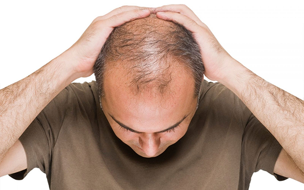 「休止期落髮」更是僅次於雄性禿的第二大宗掉髮原因
