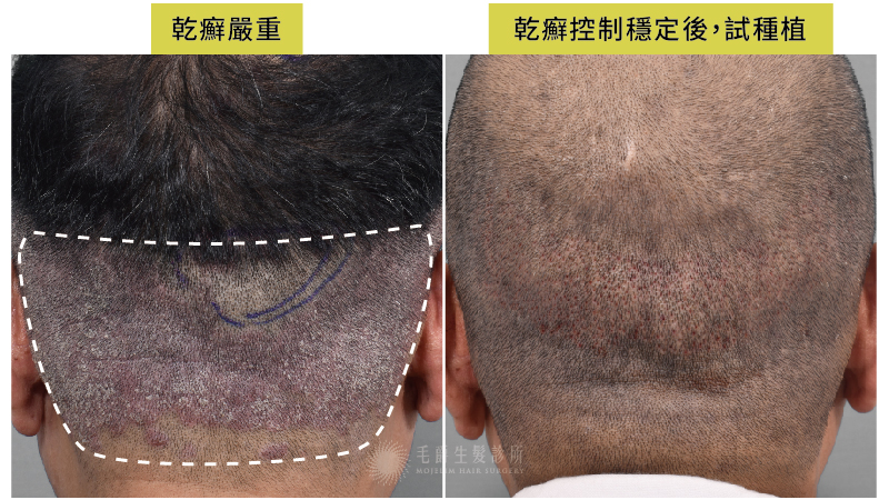 頭皮乾癬需要先穩定病情 才能植髮