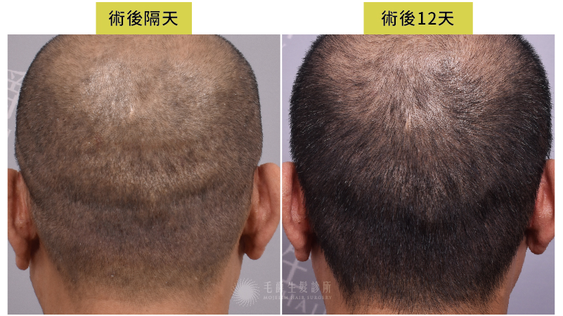 頭皮乾癬患者可以植髮