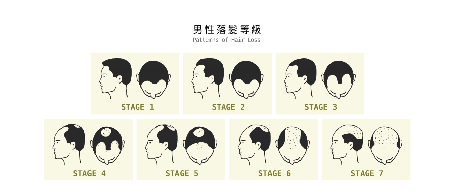 雄性禿落髮嚴重程度可以分為1到7期