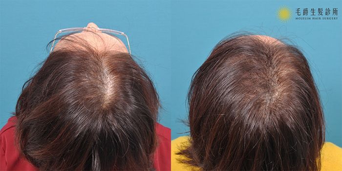 女性植髮案例頭頂植髮加密分享,可見術前後差別明顯,毛髮稀疏部位長出茂密頭髮
